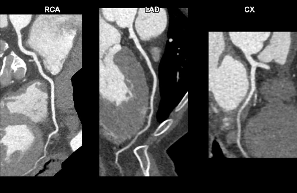 図3．動脈相RCA, LAD, LCX