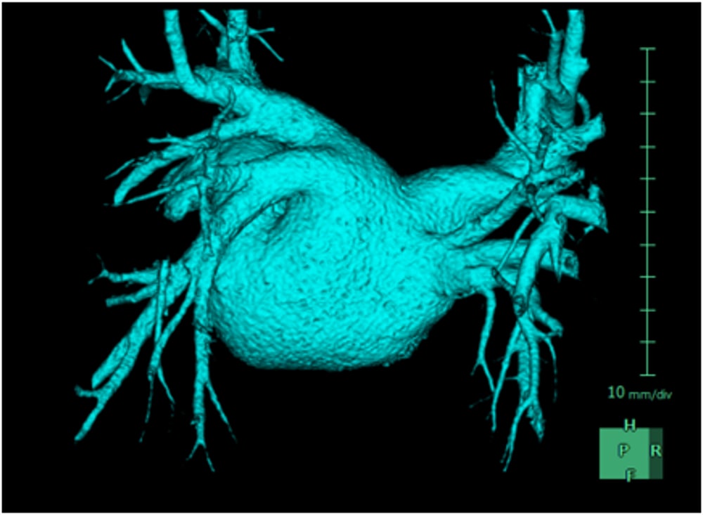 図4．肺静脈と左房のVR