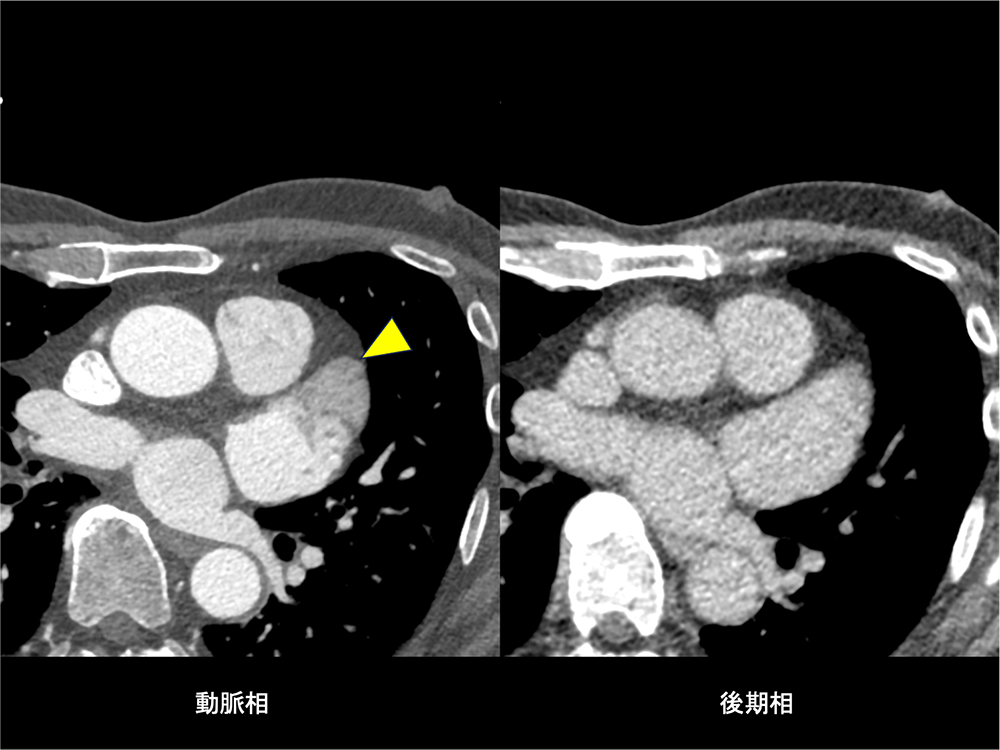 図5．左心耳遅延相(血流うっ滞)