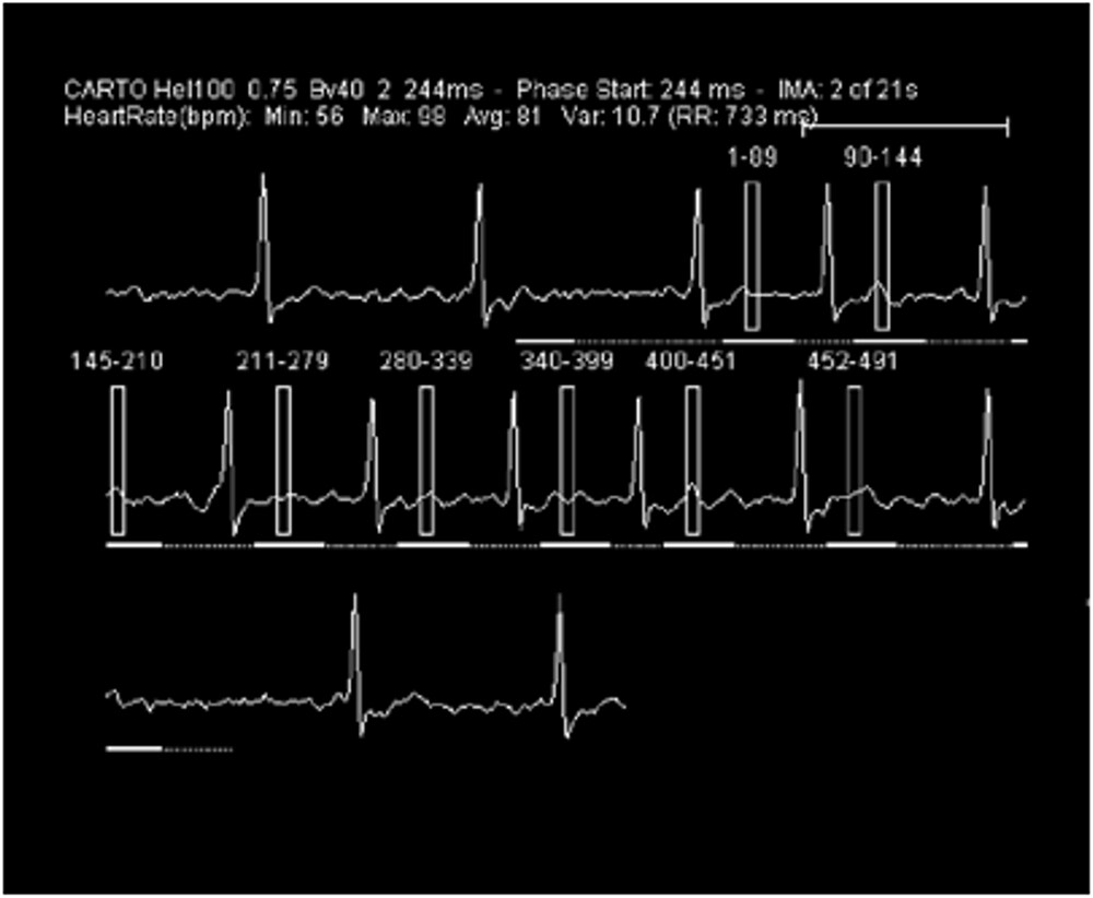 図6．撮影時心電図波形