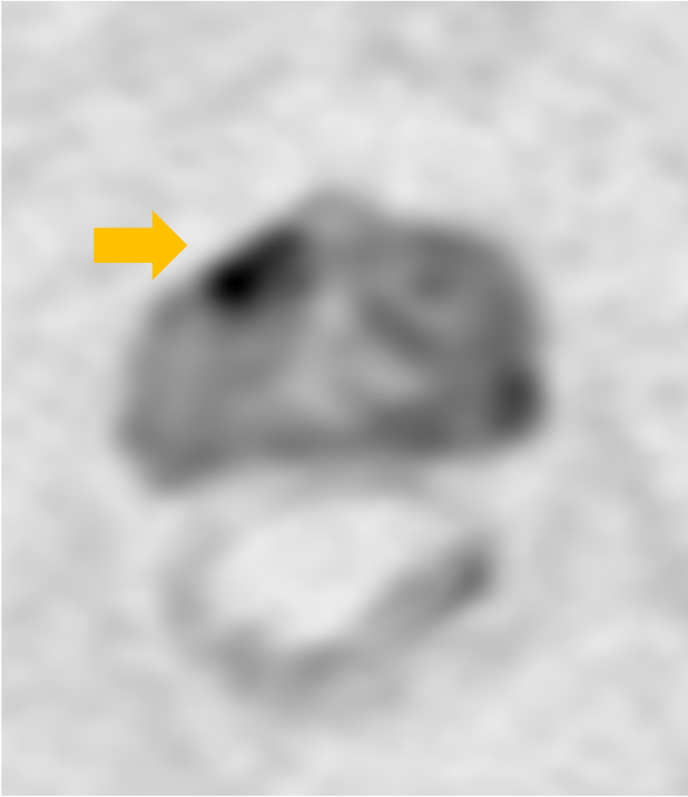 図2．拡散強調画像