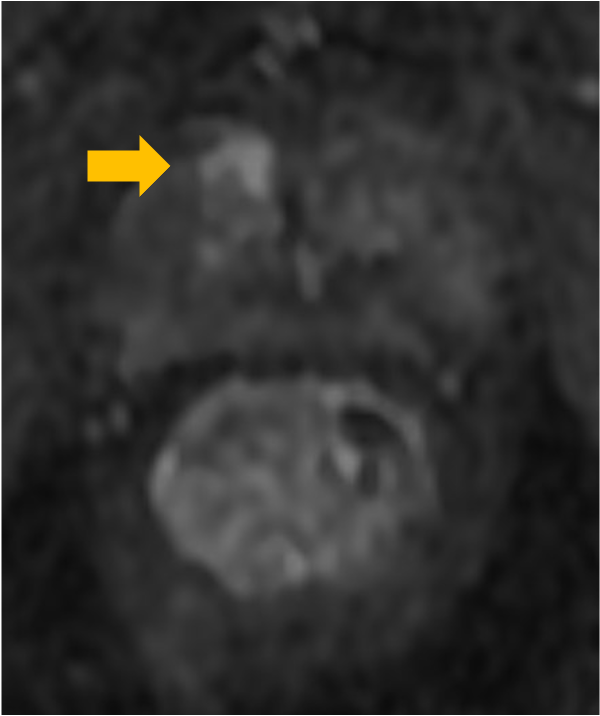 図4．ダイナミック造影75秒後