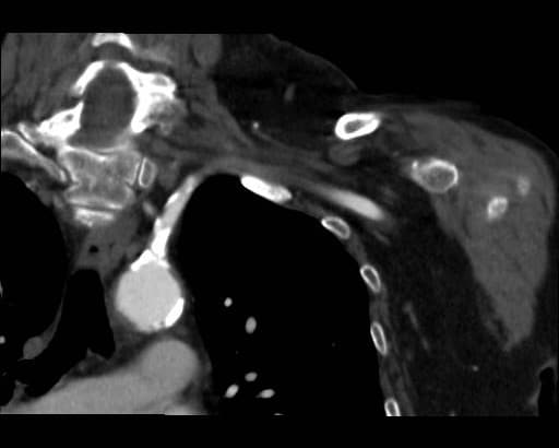 図１．造影CT早期動脈相冠状断