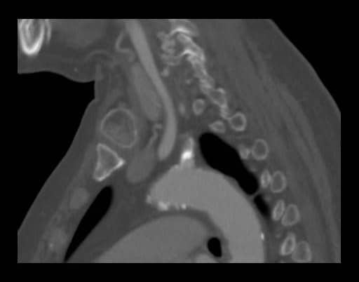 図2．造影CT早期動脈相矢状断