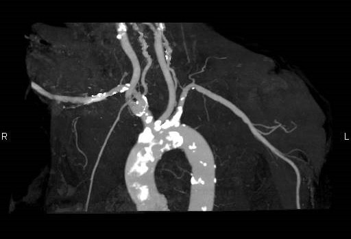 図3．造影CT早期動脈相MIP画像 LAO 45°
