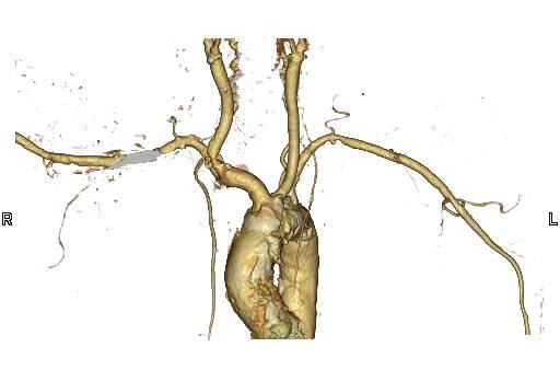 図4．胸部血管 VR (Volume Rendering) 画像 正面像