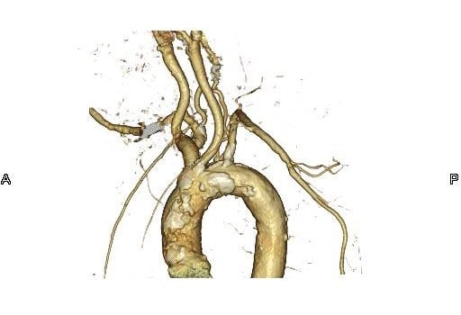 図5．胸部血管 VR (Volume Rendering) 画像 LAO 60°