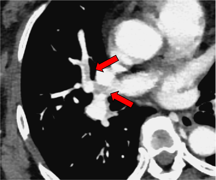図2．門脈相 MonoE 40keV画像