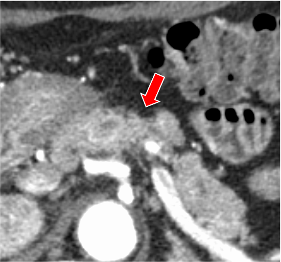 図１．膵実質相 120kVp画像