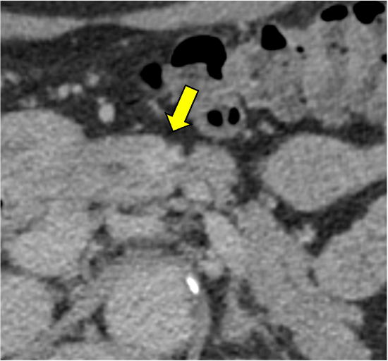 図2．遅延相 120kVp画像