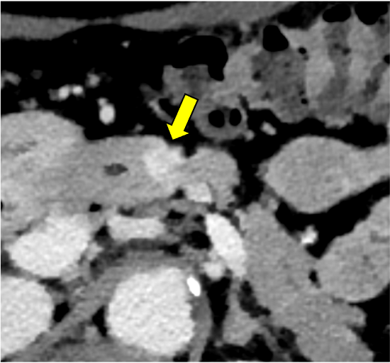 図3．遅延相 MonoE 40keV画像