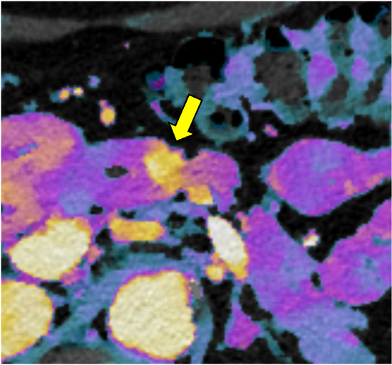 図4．遅延相 ヨード密度画像