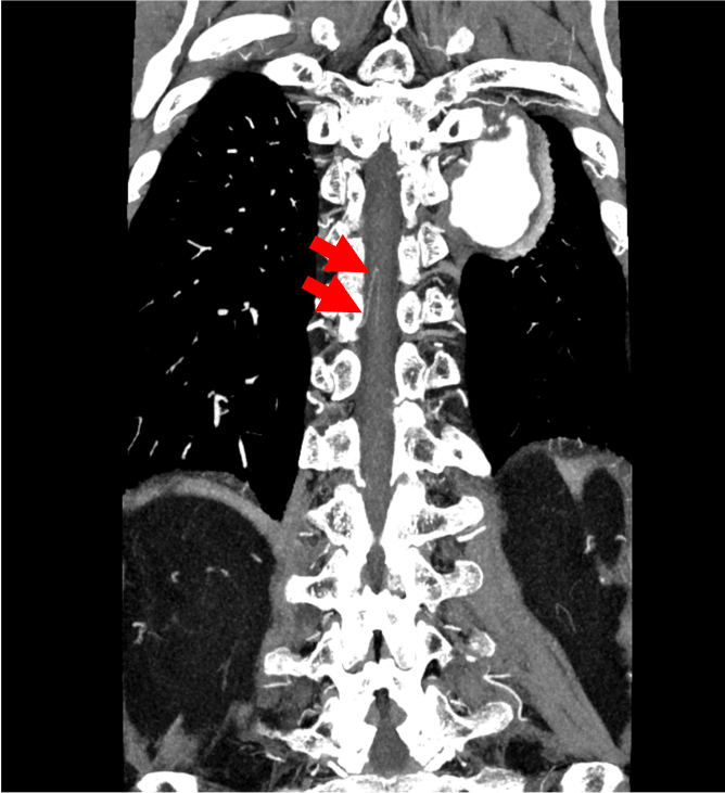 図１．動脈相のMIP像（slab 3㎜）