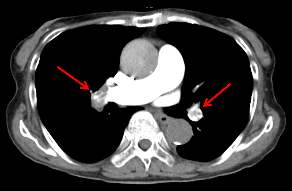 図１．治療開始前の胸部造影CT
