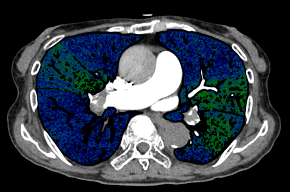 図2．図1と同部位のヨード密度画像