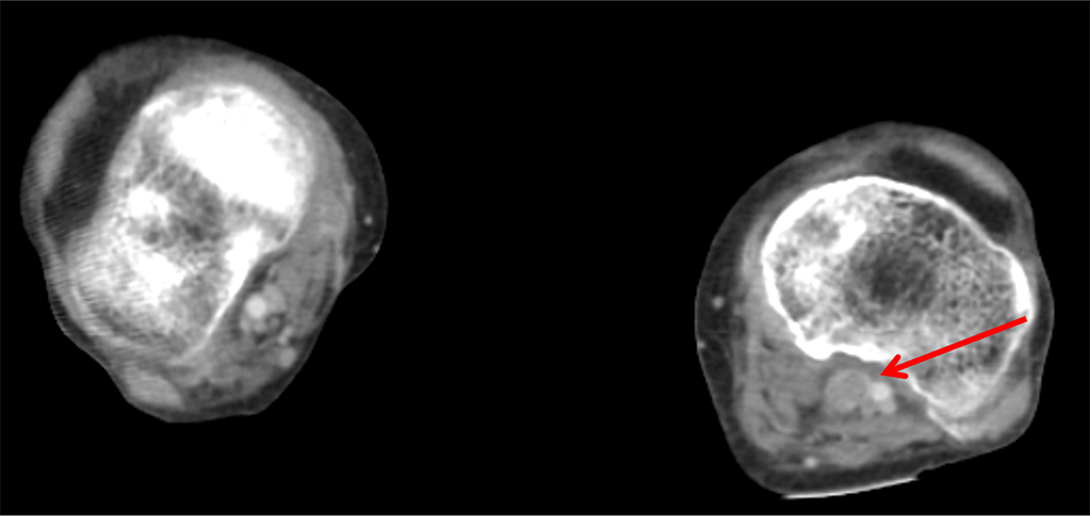 図3．図１と同時期の下腿造影CT