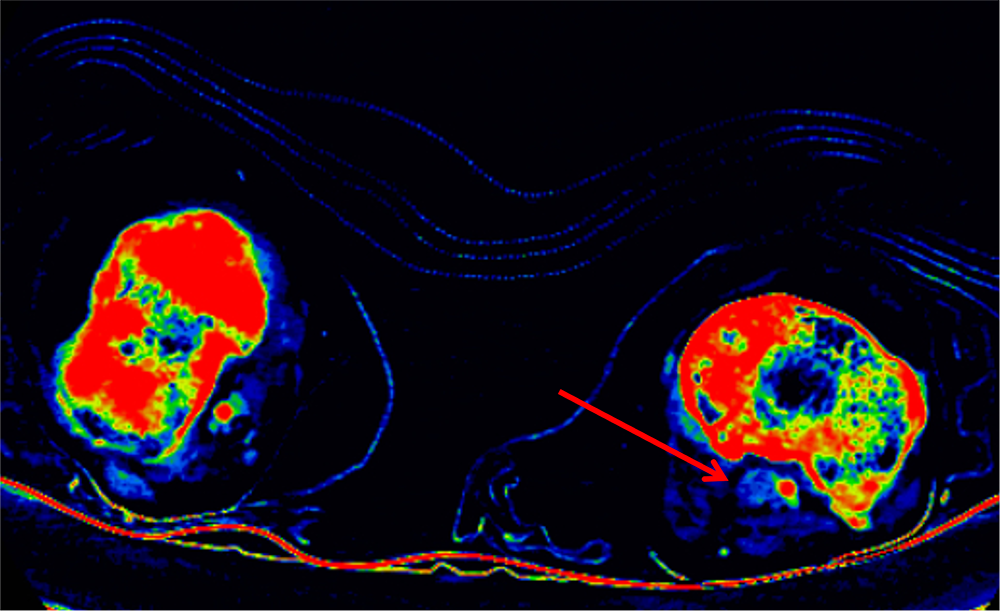 図4．図3と同部位のヨード密度画像
