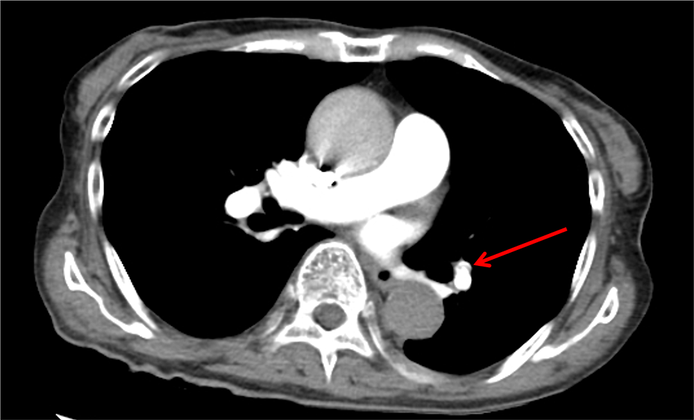図5．治療開始1週間後の胸部造影CT