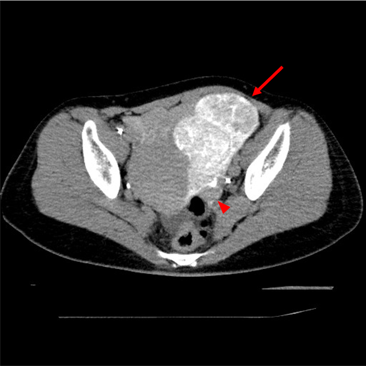 図１．左子宮動脈からの血管造影下CT (CT Uterine Arteriography :CTUA)
