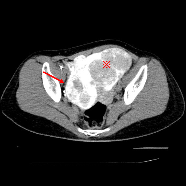 図2．右子宮動脈からの血管造影下CT (CT Uterine Arteriography :CTUA)