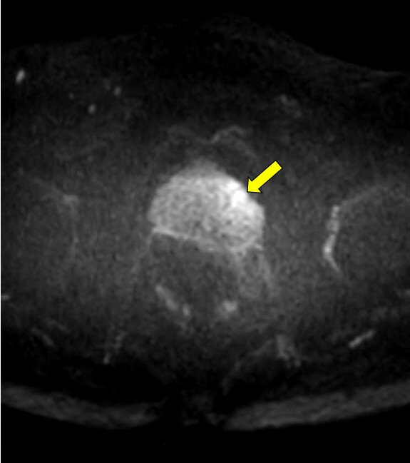 図3．拡散強調画像　b=1000, EPI