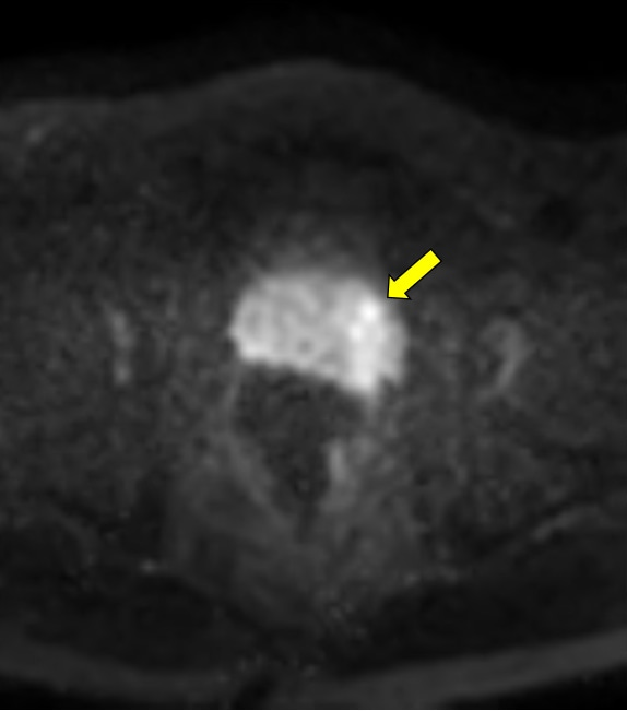 図4．拡散強調画像　b=1000, TSE