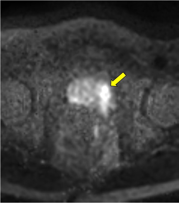 図5．拡散強調画像　computed DWI b=1400（TSE-DWI b=0, 1000で作成）