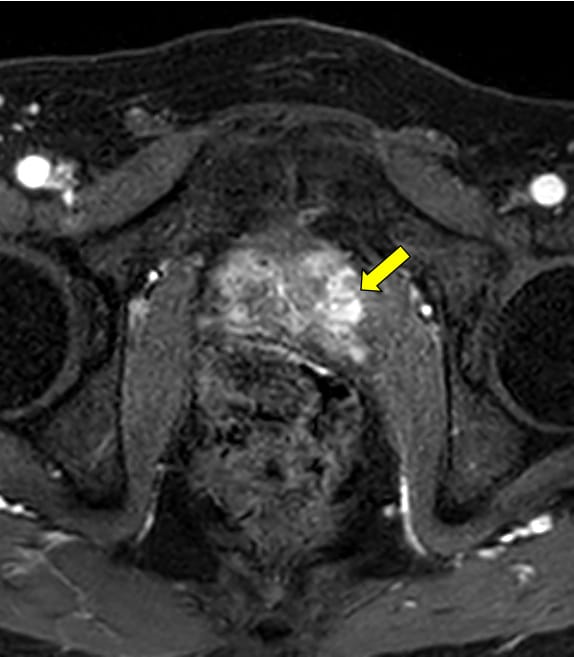 図6．ダイナミック造影動脈優位相