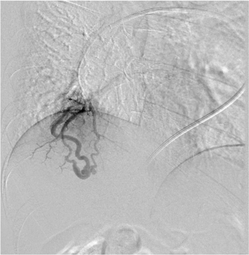 図3．右肺動脈A10造影