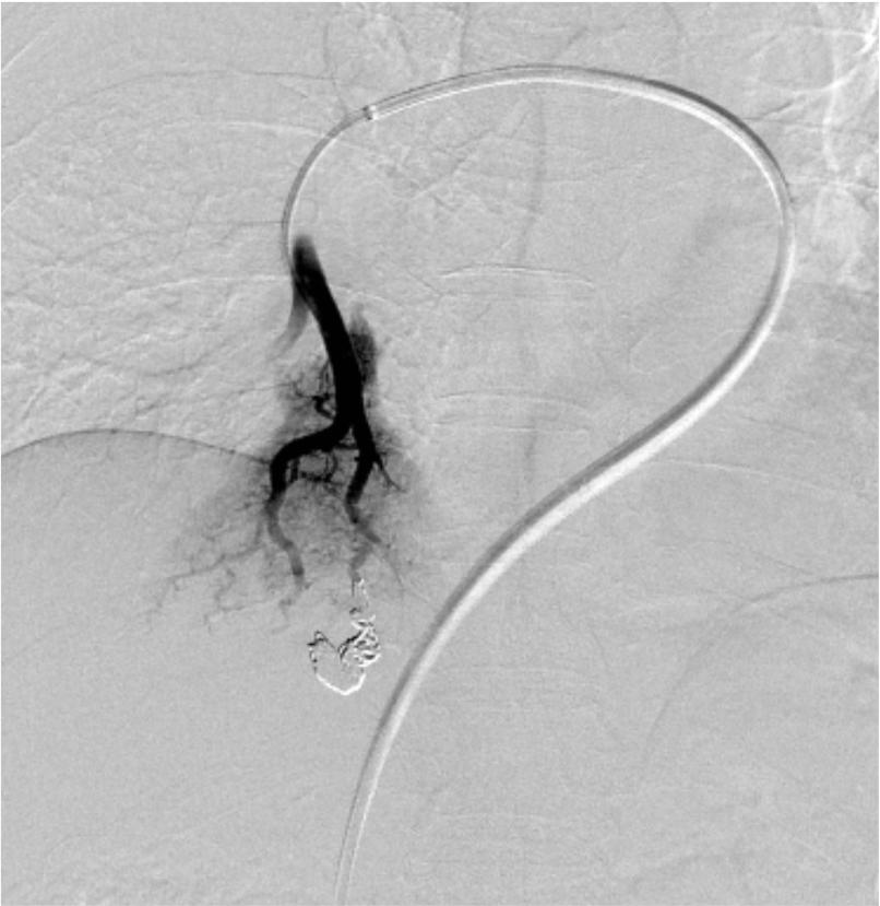 図4．コイル塞栓術後