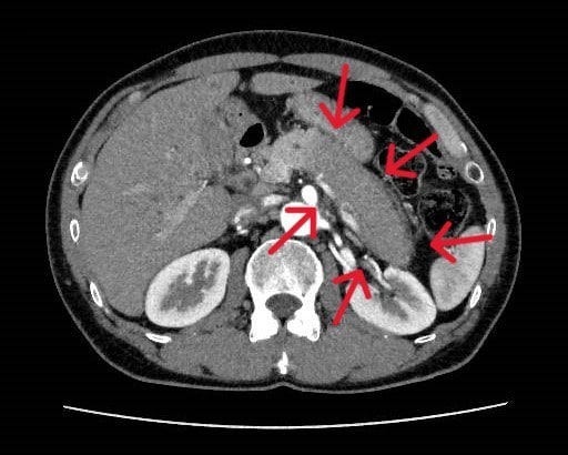 図2．後期動脈相
