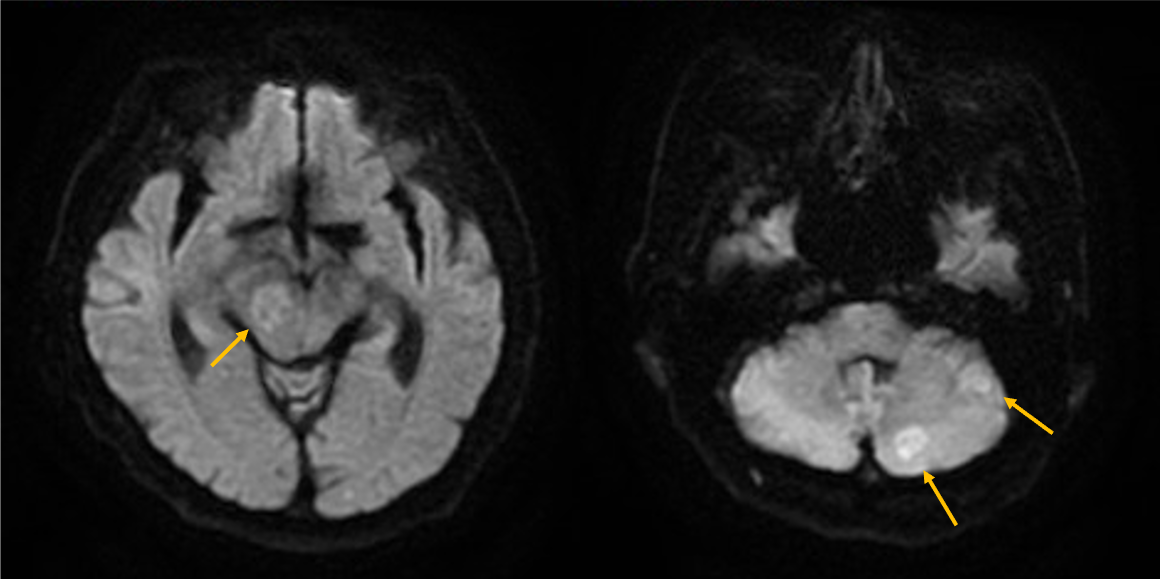 図2．拡散強調画像