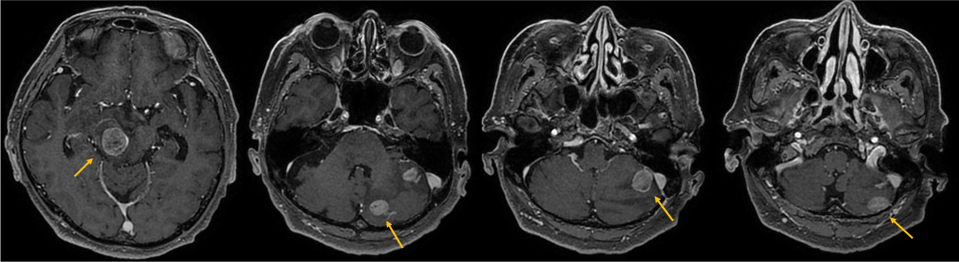 図3．造影T1強調画像（3D-FSPGR）