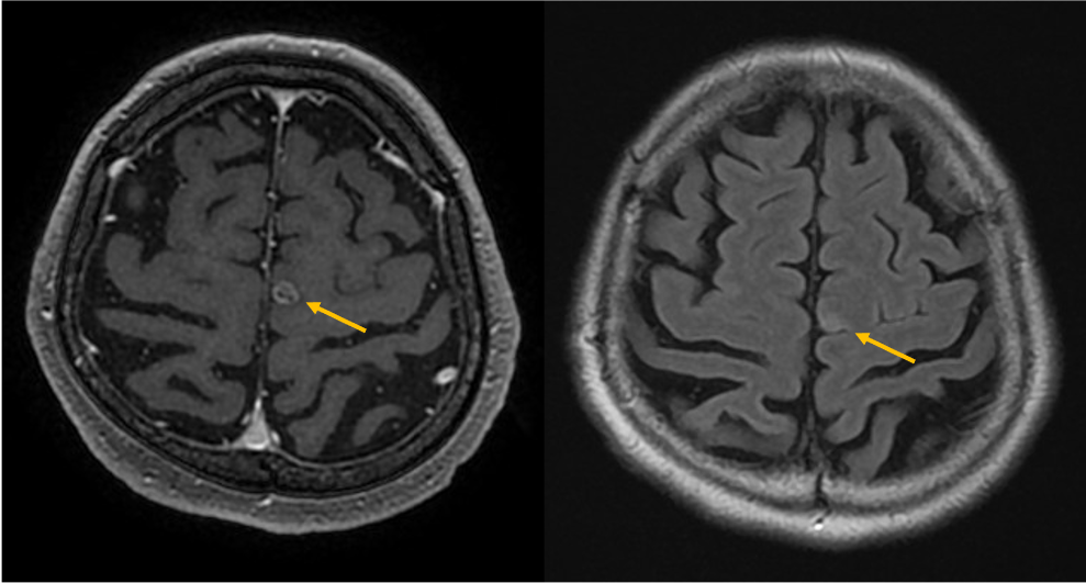 図4．造影T1強調画像（3D-FSPGR）およびFLAIR画像