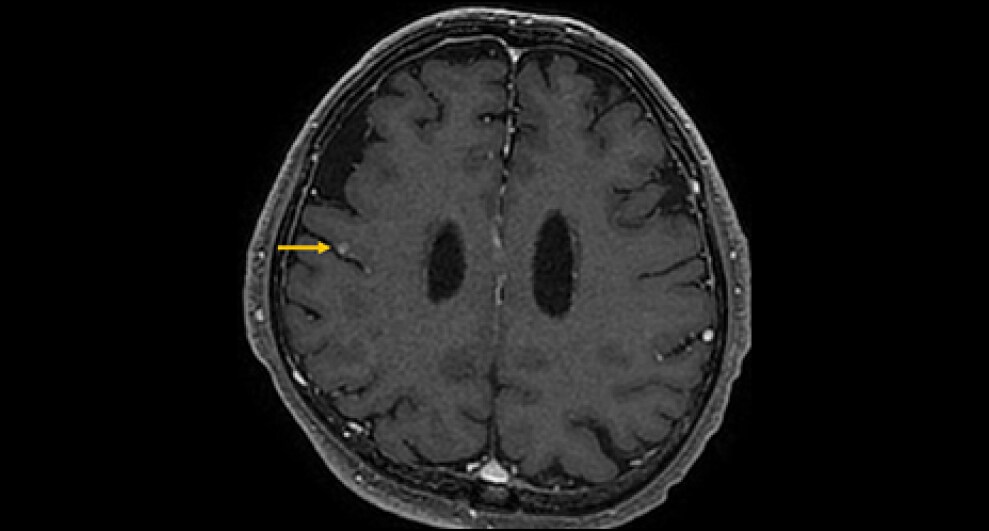 図5．造影T1強調画像（3D-FSPGR）