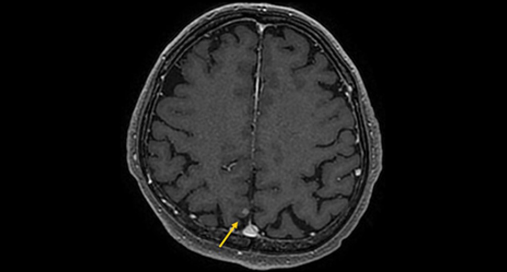 図6．造影T1強調画像（3D-FSPGR）