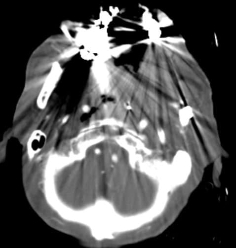 図１．動脈相　iMARなし