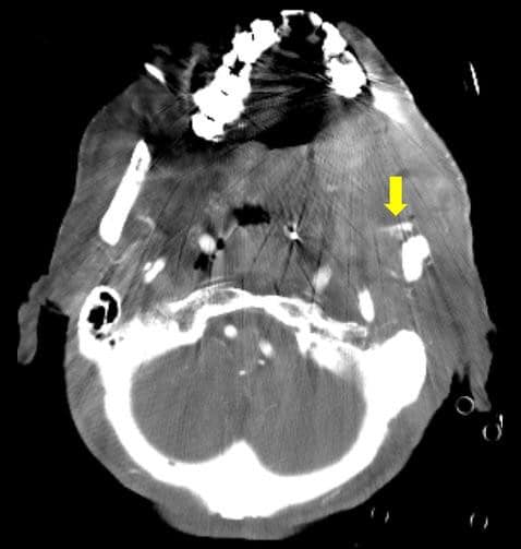 図2．動脈相　iMARあり