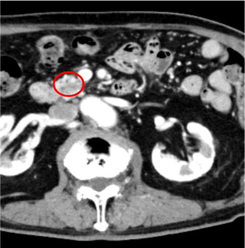 図2．門脈相(図1より45mm尾側のスライス)