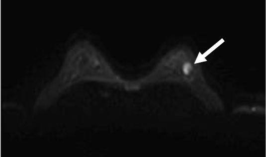 図3．拡散強調像(b=800(s/mm2)