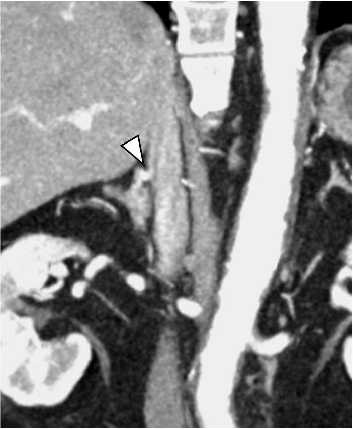 図2．後期動脈相　冠状断像
