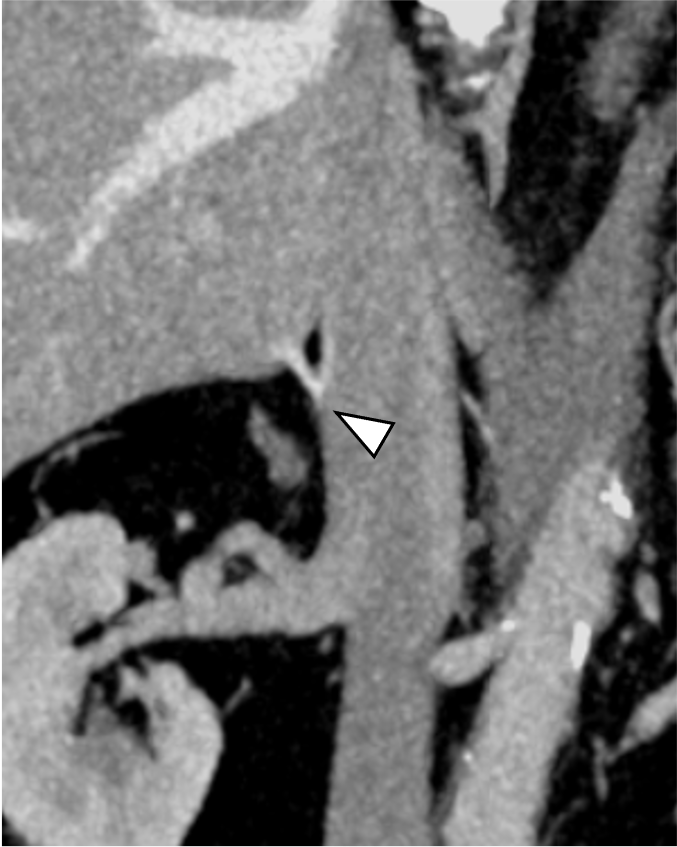 図3．門脈優位相　冠状断像