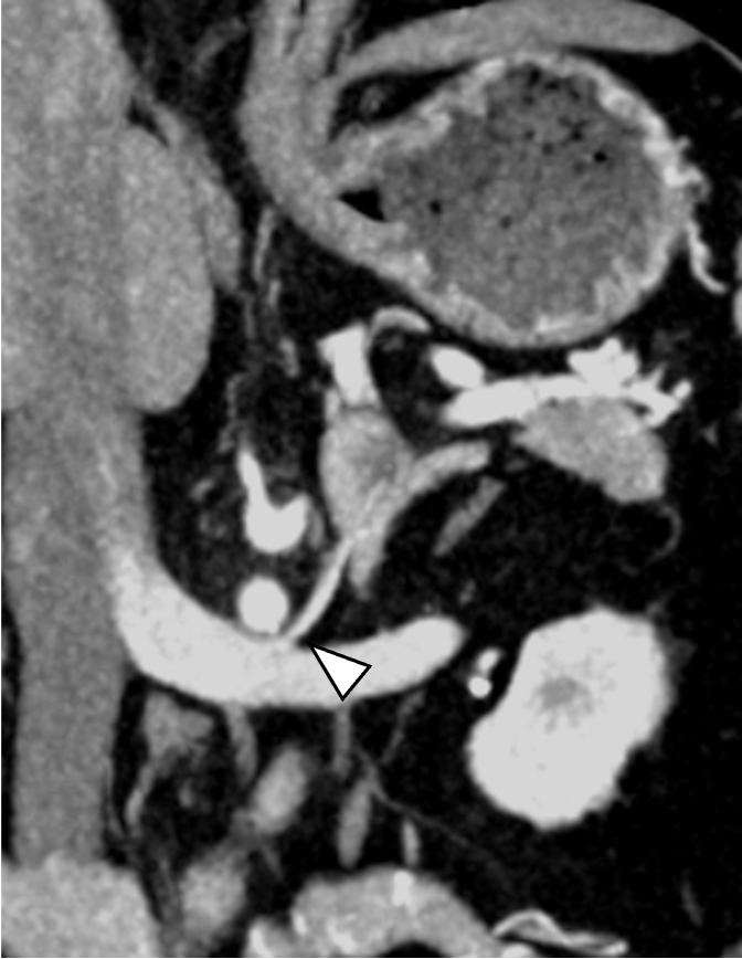 図4．後期動脈相　冠状断像