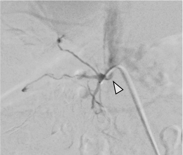 図6．右副腎静脈造影