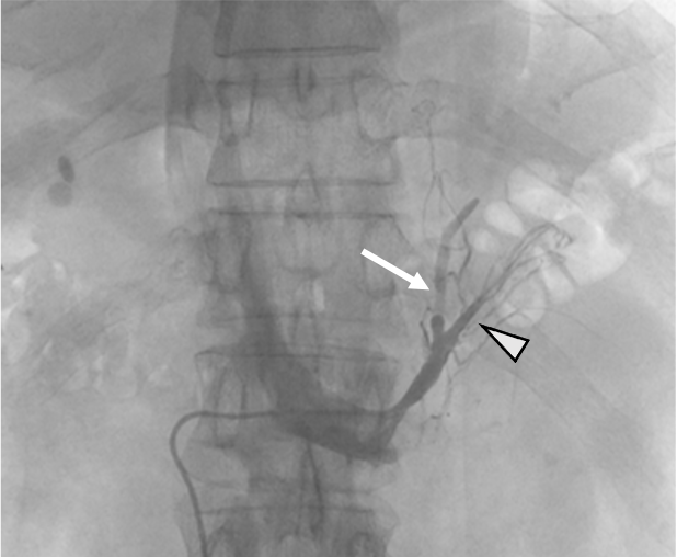 図7．左副腎静脈造影