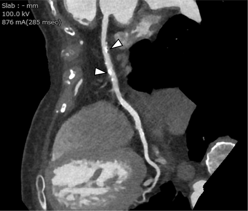 図5．curved multiplanar reconstruction(CPR)
