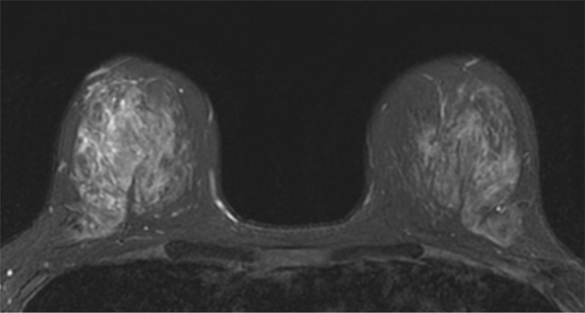 図1．脂肪抑制T2強調画像