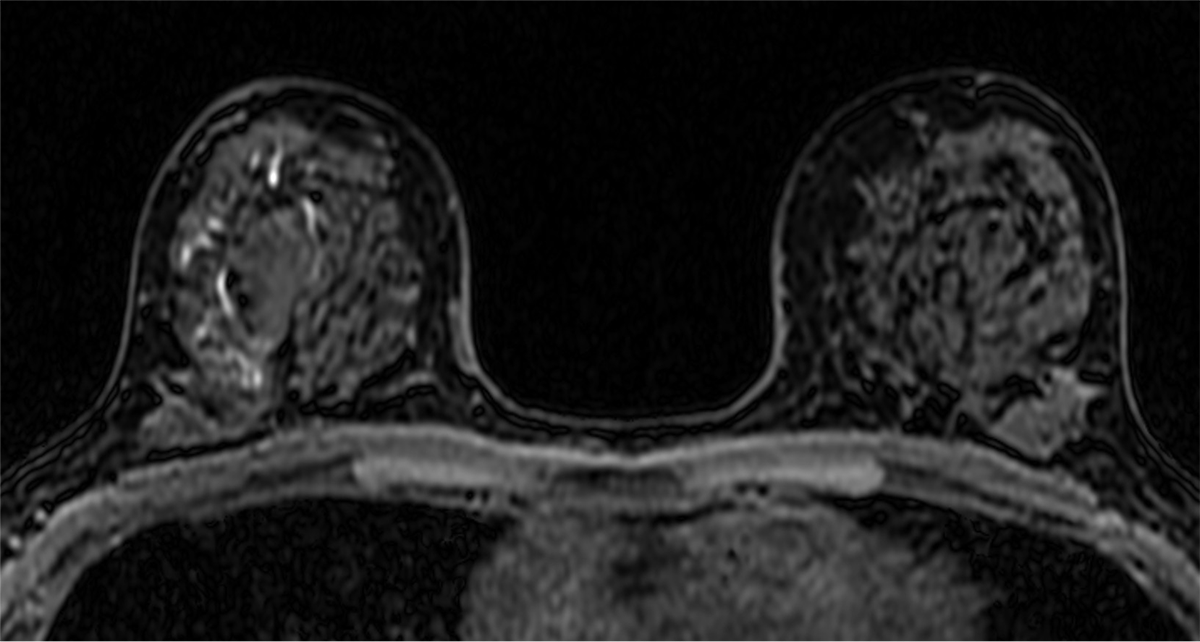 図2．造影Dynamic 造影前（脂肪抑制T1強調画像）