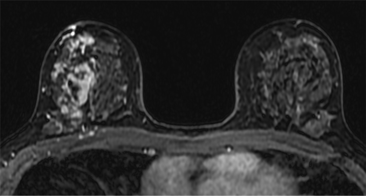 図3．造影Dynamic 早期相