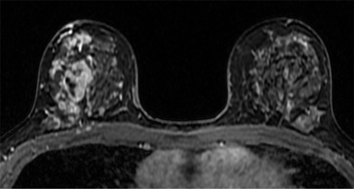 図4. 造影Dynamic 遅延相